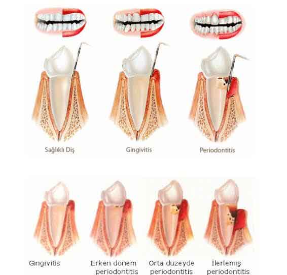 Periodontoloji (Diş Eti Hastalıkları)