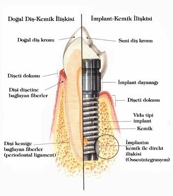 implant anatomisi